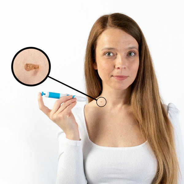 Caneta Removedora de Verrugas